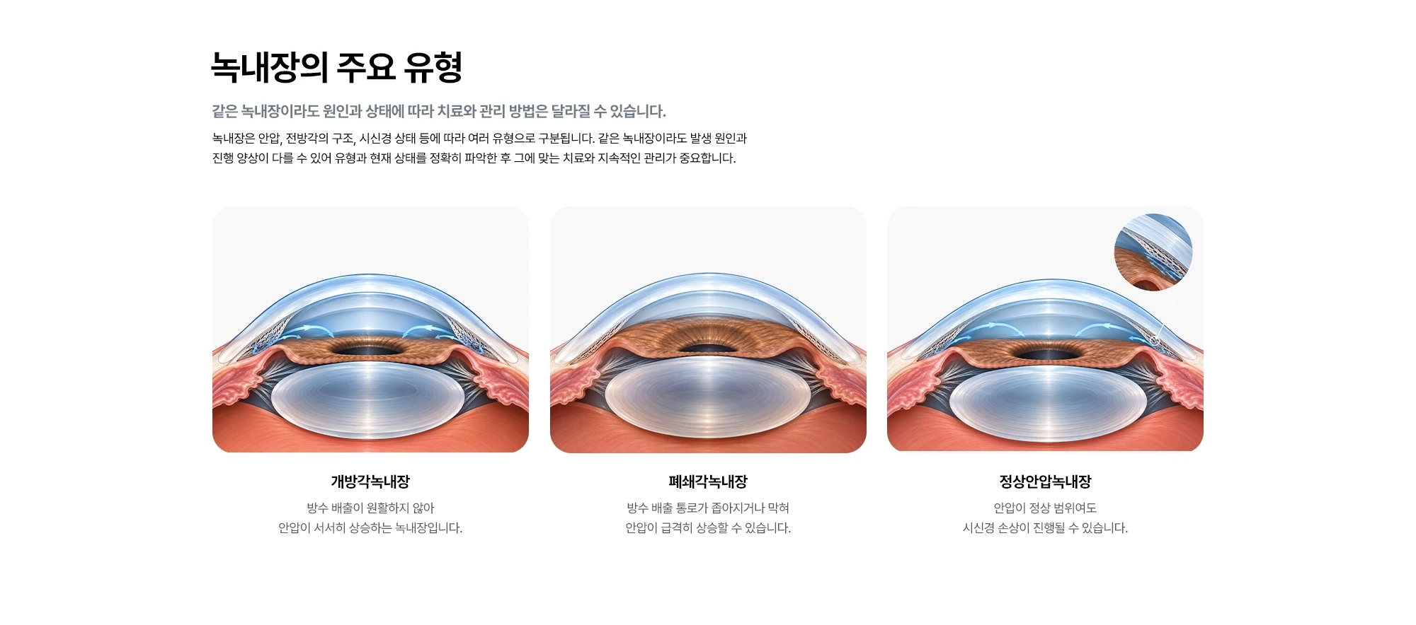 녹내장의 주요 유형 같은 녹내장이라도 원인과 상태에 따라 치료와 관리 방법은 달라질 수 있습니다. 녹내장은 안압, 전방각의 구조, 시신경 상태 등에 따라 여러 유형으로 구분됩니다. 같은 녹내장이라도 발생 원인과 진행 양상이 다를 수 있어 유형과 현재 상태를 정확히 파악한 후 그에 맞는 치료와 지속적인 관리가 중요합니다. 개방각녹내장 폐쇄각녹내장 정상안압녹내장 방수 배출이 원활하지 않아 안압이 서서히 상승하는 녹내장입니다. 방수 배출 통로가 좁아지거나 막혀 안압이 급격히 상승할 수 있습니다. 안압이 정상 범위여도 시신경 손상이 진행될 수 있습니다.