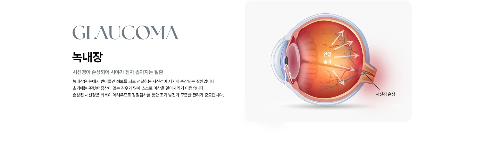 GLAUCOMA 녹내장 안압 증가 시신경이 손상되어 시야가 점차 좁아지는 질환 녹내장은 눈에서 받아들인 정보를 뇌로 전달하는 시신경이 서서히 손상되는 질환입니다. 초기에는 뚜렷한 증상이 없는 경우가 많아 스스로 이상을 알아차리기 어렵습니다. 손상된 시신경은 회복이 어려우므로 정밀검사를 통한 조기 발견과 꾸준한 관리가 중요합니다. 시신경 손상